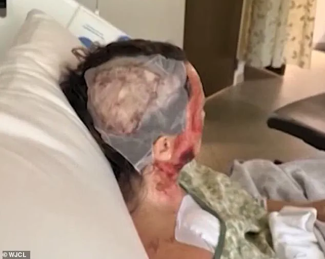 Georgia Woman Faces Millions in Medical Bills After Random Acid Attack in Savannah Park