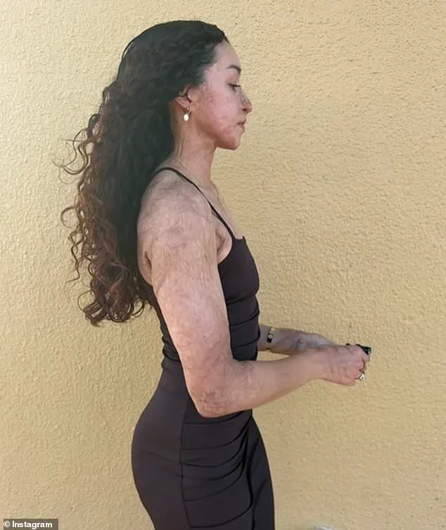 Exclusive: The Hidden Truth Behind the Acid Attack on Aspiring Bodybuilder Davina Licon