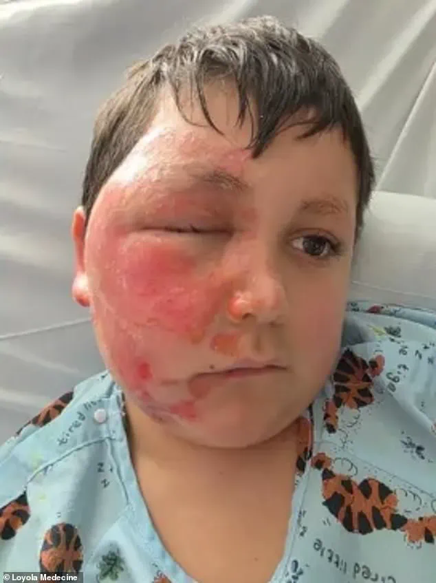 Nine-Year-Old's Severe Burns from Microwaving Sensory Toy in Viral TikTok Trend