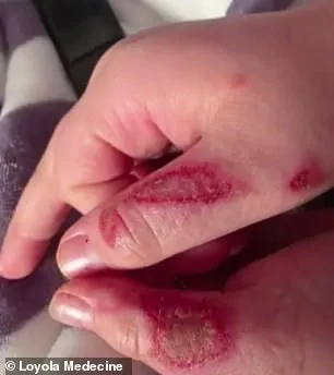 Nine-Year-Old's Severe Burns from Microwaving Sensory Toy in Viral TikTok Trend