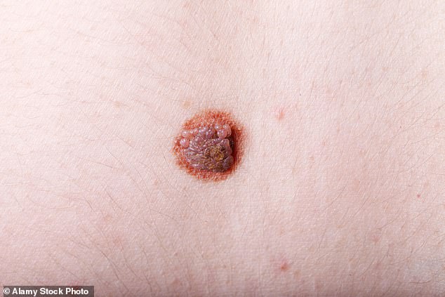Skin cancer cases poised to surge globally by 2050, driven by UV exposure.
