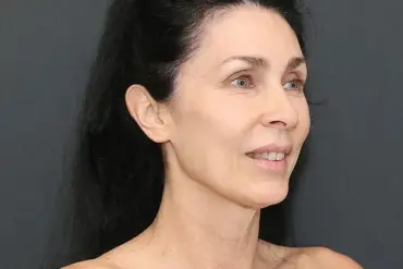 AI Flags 'Too Perfect' Facelift Result, Sparking Debate on Cosmetic Standards